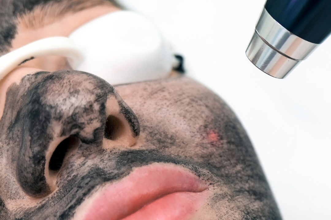 carbon laser peel